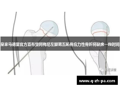 皇家马德里官方宣布楚阿梅尼左脚第五跖骨应力性骨折将缺席一段时间 皇家马德里官方宣布楚阿梅尼左脚第五跖骨应力性骨折将缺席一段时间